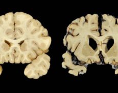 BU researchers in early stages of being able to diagnose CTE in the living